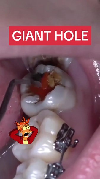 Teeth are the hardest substance in the body yet if neglected they can rot and become extensively decay leading to infection & pain. #purpledentalcare #dentalcaries #dentalhygienist #bristol