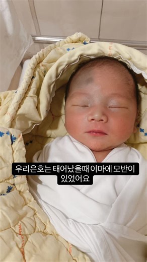 으노 은째 on Instagram: "안녕하세요 으노에요!! 생각보다 모반을 가지고 계신 분들과 관심을 가져주시는 분들이 많아서 게시물을 만들어 보았어요!! 최대한 많이도움드리고 싶어서 없는 실력으로 편집도 해보고 영상도 올려 봅니다:) 저희 은호는 선천성 모반(오타모반)을 가지고 태어났어요!! 지금은 치료가 다 끝나서 깨끗해졌구요😍 전문가는 아니라 크게 도움이 안될수도 있겟지만, 영상 꾸준히 만들어서 올리구, 궁금하신것들 최대한 답변해 드릴게요:) 조금이라도 도움이 되고싶어서.. 시작해 보겠습니다!! 좋은 마음으로 봐주세요:) 은호는 생후 70일정도부터 치료를 시작햇어요!! 처음엔 이마에만 있던 모반이 볼 쪽 까지 나타났구여.. 애기라 마취를 할 수 없어서.. 마취 크림만 바르고 치료를 했답니다. 한번에 많은 부위를 하면 아이에게 부담이 되서 저렇게 삼등분으로 기준을 잡고 한부위당 한달 기간을 두고 치료했어요 (2월달엔 1번부위, 3월달엔 2번부위, 4월달엔 3번부위) 이런식으로