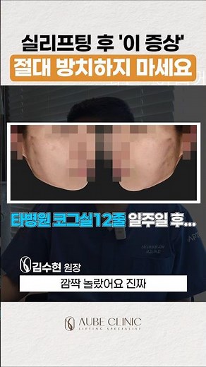 실리프팅 부작용, 복원하는 방법📌#실리프팅부작용 #실리프팅부작용치료병원 #실리프팅전문 #실리프팅잘하는곳 #오브의원