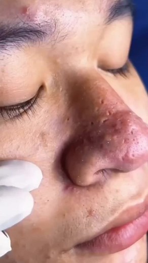 pimplepoopper (@pimplepoopper)’s videos with Chill Vibes - Tollan Kim
