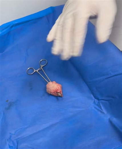 22 Fr BipoLEP 💪Enbloc 💡Combined with management of a sizable bladder stone (open retrieval) 🪨in 35 minWith Zero bleeding 🩸 @BernardoNor9 🔜 22 Fr is on track to become the new standard. @RomanCarvajal