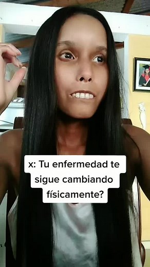 Esclerodermia Sistémica: Síntomas, Tratamientos y Experiencias