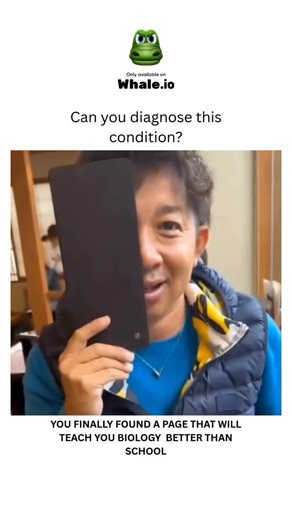 BIOLOGY | MEDICAL | HEALTH on Instagram: "Bell’s palsy is a condition causing sudden, temporary weakness or paralysis on one side of the face. It’s often linked to inflammation of the facial nerve and can result in drooping eyelids, difficulty smiling, or closing the eye. The exact cause is unclear, but it’s believed to be related to viral infections. Most people recover fully with or without treatment, though some may experience lasting effects. Bell’s palsy is a condition that causes sudden we
