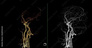 CTA brain or Computed tomography angiography of the brain 3D Rendering image for finding Stroke and aneurysm disease .