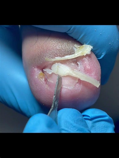 Trim oversized NAILS that grow into the flesh #satisfying #pedicure