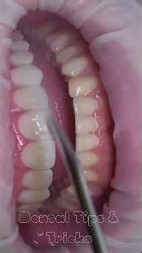 Composite Polishing Steps...😬✨#dentist #dentaleducation #trending #polish #shortsfeed