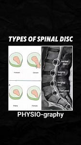 Disc bulge stages | PHYSIO-graphy