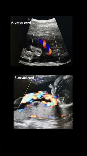 Two Vessel Umbilical Cord?