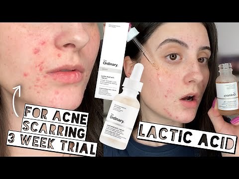 TESTING THE ORDINARY LACTIC ACID 10% + HA ON ACNE SCARS FOR 3 WEEKS | Sensitive + Dry Skin