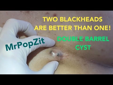 Double barrel, double blackhead, double pore, double your fun cyst! It goes deep! Dried out contents