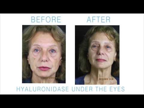 Hyaluronidase Hyalase How to Remove Dermal Skin Filler