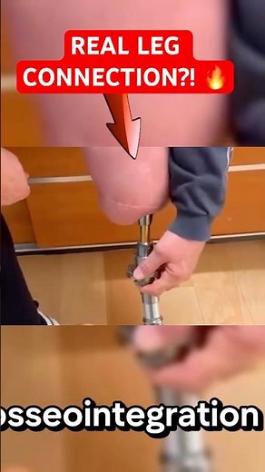 This New Tech Replaces Painful Socket Prosthetics