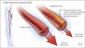 Peripheral artery disease can signal cardiovascular trouble for heart, brain and legs  - Mayo Clinic News Network