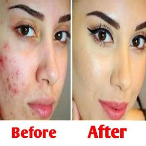 6 home remedies to get rid of acne | Health Tricks & Tips English