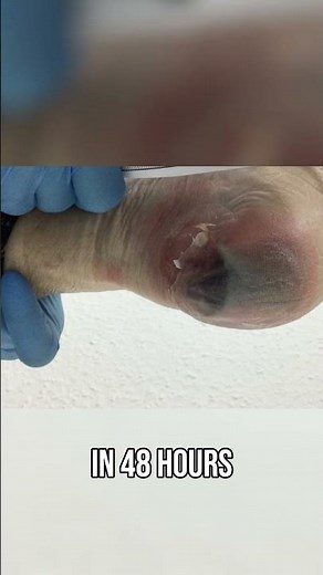 Diabetes Foot Check Prevent Amputation With This Simple Routine!