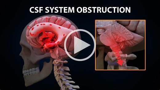 CSF System Obstruction