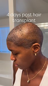 I went to Turkey and got a hair transplant because I had thin edges and a bald spots near my crown. This is day 4 since. #hairtransplant #hairtransplantturkey | Tia Nate'