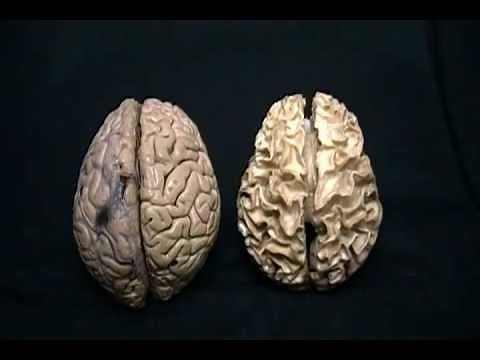 NEUROANATOMÍA 2.0: DISECCIÓN VISTA DORSAL DEL ENCÉFALO (1)