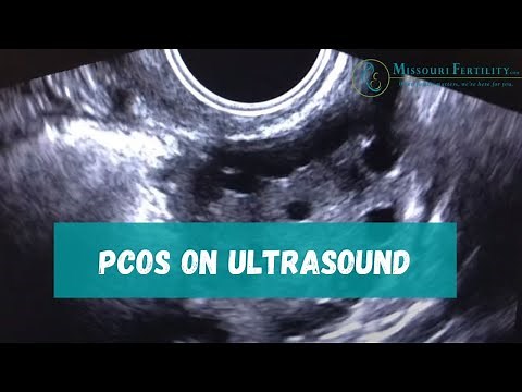 PCOS: Sonogram and Discussion