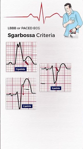 Sgarbossa Criteria to detect Acute MI in LBBB and Paced ECG #shorts