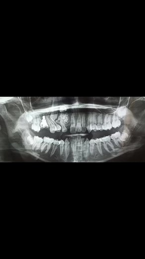 El Odontoma Compuesto es un tipo de tumor benigno odontogenico, donde se forman dientes pequeños (denticulos) dentro de una capsula bien definida. En este caso intervino en la erupcion de los dientes 22 y 23 quedando impactados. . . #cirugiaoral #cirugiadental #odontologia #santacruzdelasierra🇳🇬 #bolivia🇧🇴 #fyp #CMF #CapCut