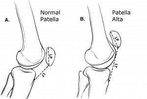 膝蓋骨高位 (Patella alta)｜膝の整形外科医-学びの部屋-