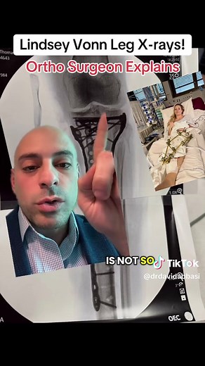 Lindsey Vonn is sharing her journey - X-rays and all. 🩻🦴🫣 Those plates and screws you see? They’re designed to stabilize the bone, restore alignment, and allow proper healing after a fracture. The hardware acts as an internal support system while the body does the real work — rebuilding stronger than before. Strength isn’t just physical. It’s the courage to show the process. What a LEGEND!⛷️💪 #lindseyvonn #olympics #ski #sports #medicine