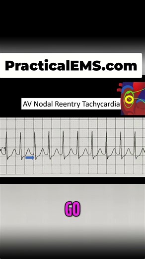 AV Nodal Reentry Tachycardia: Heart's Electrical Chaos Explained! #shorts