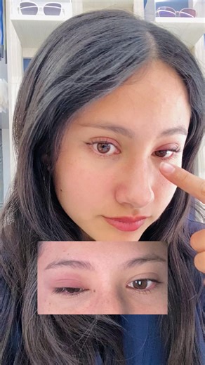 Orzuelo interno: mi experiencia y consejos