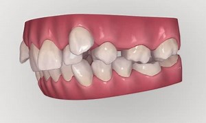 Invisalign for extreme crowding