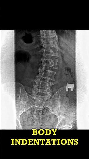 Spine X-Ray: Spot the Scoliosis! #radiologyShort