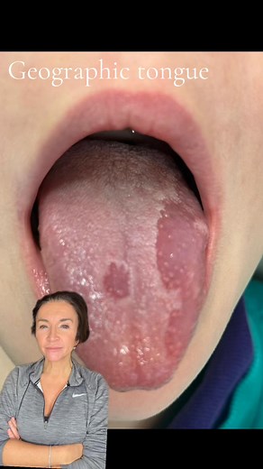 Geographic Tongue: Causes & SymptomsEver noticed irregular, map-like patches on your tongue? This could be geographic tongue—a harmless yet sometimes uncomfortable condition.Causes🦷 The exact cause isn’t fully understood, but factors may include:✔️ Genetics – It tends to run in families✔️ Nutritional Deficiencies – B12, iron, or zinc deficiencies✔️ Hormonal Changes – Some notice flare-ups with stress or hormonal shifts✔️ Allergies or Sensitivities – Certain foods (spicy, acidic) may trigger dis