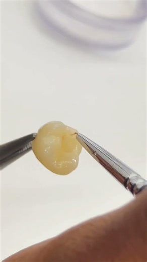 Dental Crown Staining | Natural Shade in Progress 🦷🎨