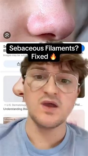 How to treat and minimise sebaceous filaments.