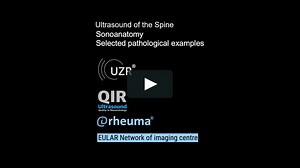 Ultrasound Guided Spine Interventions