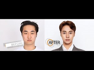 Male Plastic Surgery Transformations | Seoul Guide Medical