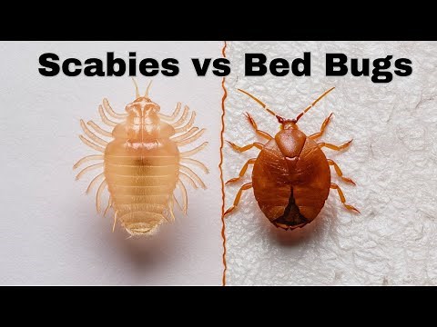 Scabies vs Bed Bugs