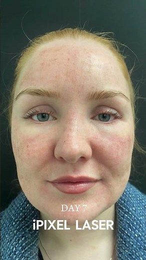 I Tried iPixel Laser – You Won’t Believe the Before & After! - DrMediSpa