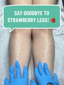 426K views · 6.3K reactions | Say goodbye to strawberry legs! 勺A few things that usually help my clients with their strawberry legs are.. Exfoliating, hydrating, moisturizing, and remaining consistent with her waxing appointments! #fyp #legs #wax #esthetician #waxing #trending #bubblegum #mix #satisfying #educational #strawberry #leg #goviral #howto #skincare #skincareroutine #skincaretips #reelsfacebook | Waxing Queen | Facebook