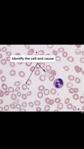 Lab Tech on Instagram: "Identify the blood cell 🔬 One slide can tell a whole story. 🩸 RBC (Red Blood Cells) Target cell – RBC with central bull’s-eye; seen in thalassemia. Sickle cell – Crescent-shaped RBC due to HbS mutation. Spherocyte – Small dense RBC without central pallor; hereditary spherocytosis. Schistocyte – Fragmented RBC from intravascular hemolysis. Elliptocyte – Oval-shaped RBC in hereditary elliptocytosis. Acanthocyte – Spiky RBC seen in liver disease. Echinocyte – Burr-shaped R