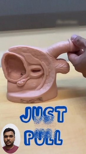 Bladder Stone Removal|Bladder Stone|