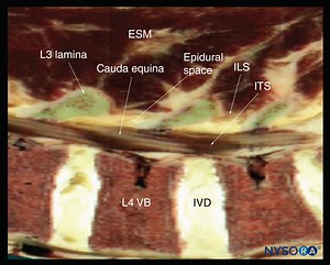 Spinal Sonography and Applications of Ultrasound for Central Neuraxial Blocks - NYSORA