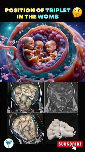 Position of the triplet in the womb | Triplets | Pregnant with triplets #shortsfeed #triplets #baby