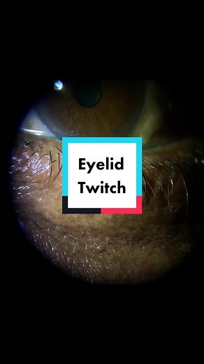Understanding Eyelid Twitching and Myokemia: Causes and Solutions