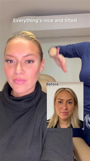 Marg Skorka | Nurse Practitioner on Instagram: "@kayajones is looking amazing and loving her Radiesse® Hyperdilute results ✨ Radiesse® Hyperdilute is the ultimate skin-quality treatment designed to stimulate your own collagen, not add volume. Here’s why everyone loves it: -Improves skin texture & firmness -Boosts collagen and elastin over time -Enhances elasticity and radiance -Natural-looking, gradual results -Great for face, neck, décolleté, arms & body"