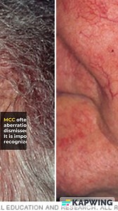 Merkel Cell Carcinoma: Symptoms, Causes, and Early Detection