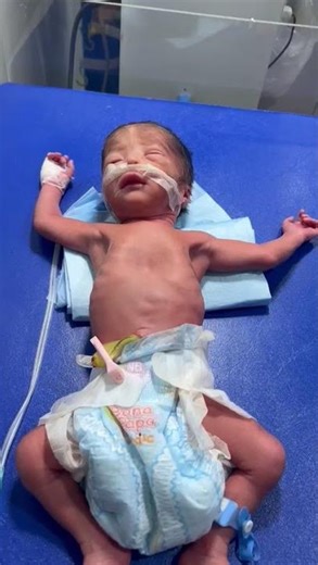 Graunting and respiratory distress baby