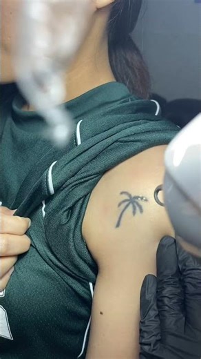 Another laser tattoo removal
