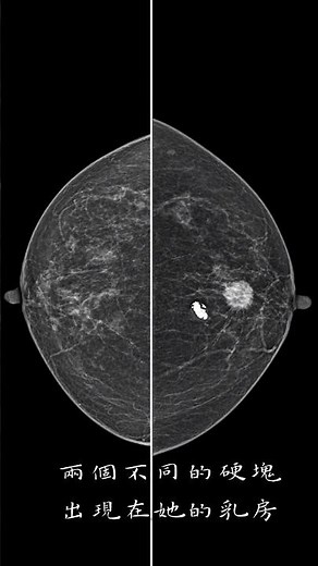 跟據病人主訴乳房硬塊，年齡超過60歲，有乳癌家族史，再加上理學檢查左側乳房凹陷，我已經診斷她為乳癌。