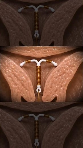 IUD Explained : The Most Effective Birth Control || 3d animation || #viral #coppertube #anatomy